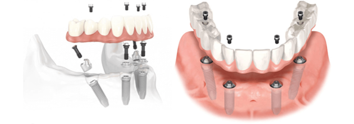 Имплантация Зубов All On 4 Цена К31